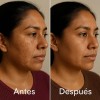 Crema Quita Manchas, Antiarrugas, Paño Con Acido Hialurónico