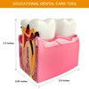 Dental Caries Teeth Model, 3.4 x 3 x 2 Inches