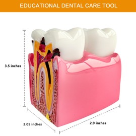 Dental Caries Teeth Model, 3.4 x 3 x 2 Inches - 6 Times Enlarged Dental Anatomy Education Tooth Model - Caries Teaching Typodont Tool for Dentists, Patients, Teachers, and Students