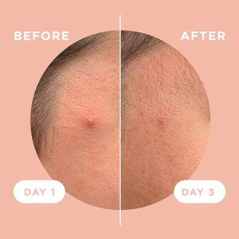 ZitSticka Killa Acne Patches for Face - World's Most Potent
