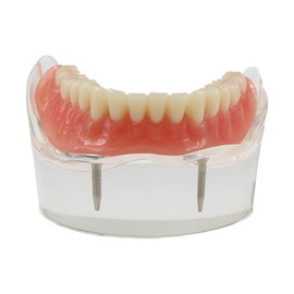 Dental Implant Teeth Restoration Model Mandibular Overdenture with 2 Implants