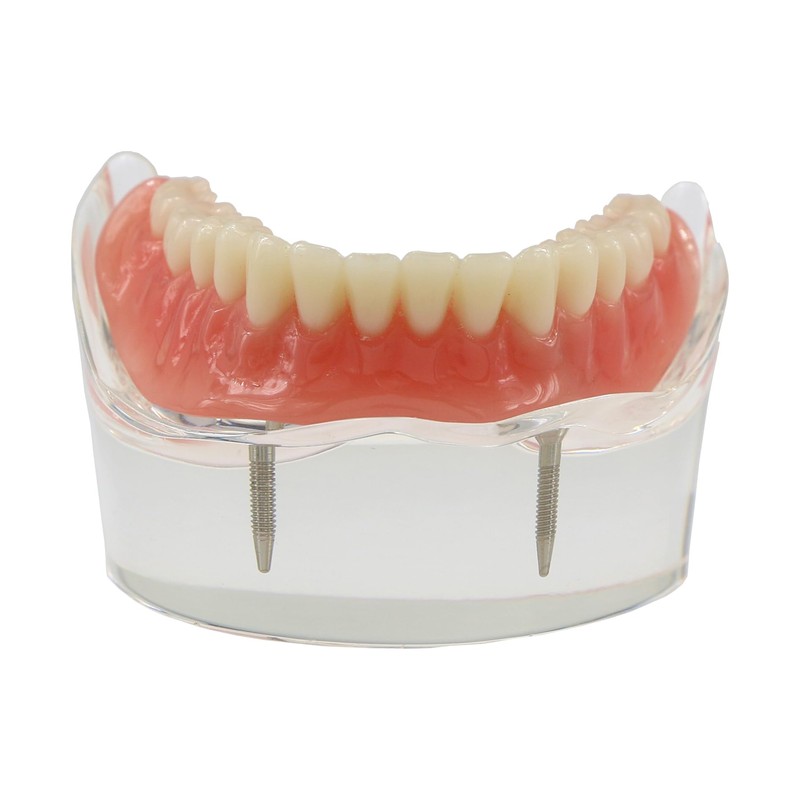 Dental Implant Teeth Restoration Model Mandibular Overdenture with 2 Implants