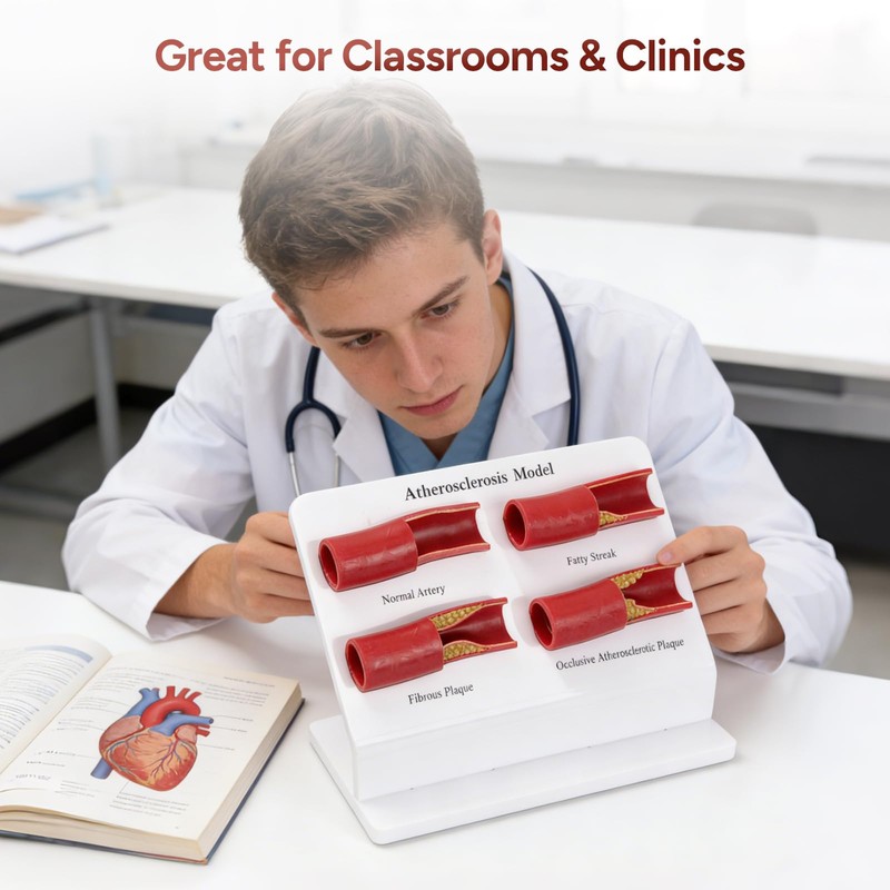 Simedutech Atherosclerosis Model, Artery Plaque Display,Vascular Disease
