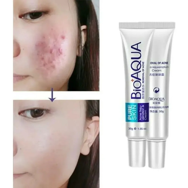 Bioaqua Acne Cream reduce cicatrices, poros y grasa, cuidado continuo