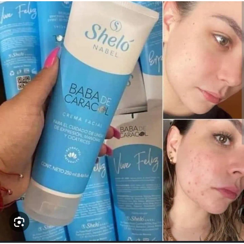 Olvídate Manchas Líneas Expresión Shelo Nabel