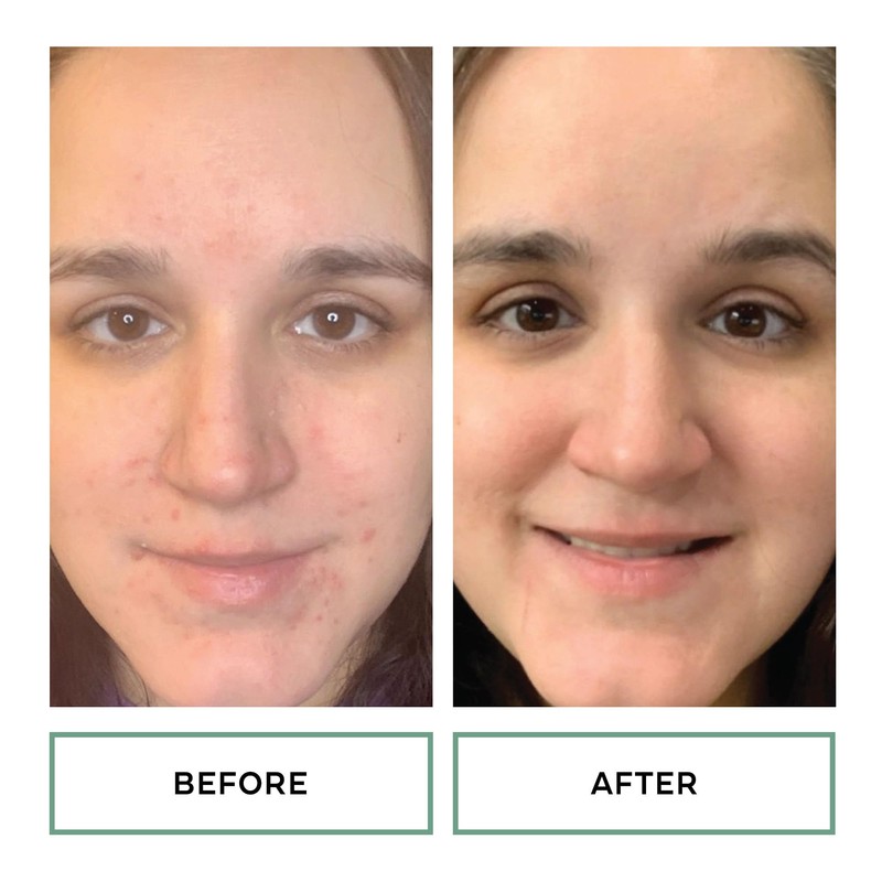 Replenix 10% Benzoyl Peroxide Wash, Advanced Acne Cleanser for Face