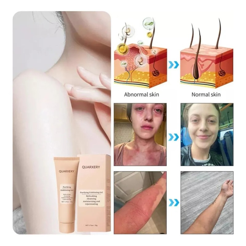 - Gel Exfoliante Quarxery, Gel Exfoliante Suave, Paquete De