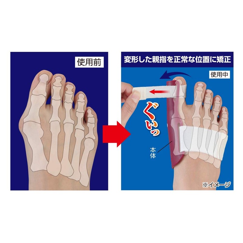 プラスウォーク 一般医療機器 外反母趾矯正プロテクター 【左用】 就寝用外反母趾サポーター 変形した親指を矯正
