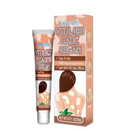Vitiligo Cream, Natural Effective Vitiligo Treatment for Reduce White Spots and Improve Skin Pigmentation