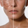 2 Cremas Blancoderma Quita Manchas Piel Facial Aclarador Bla Mixta