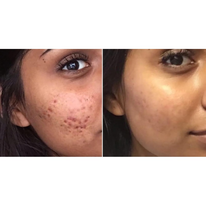 Fast-Acting Acne Scar Treatment Cream - 24-Hour Spot Reduction, Anti-Acne