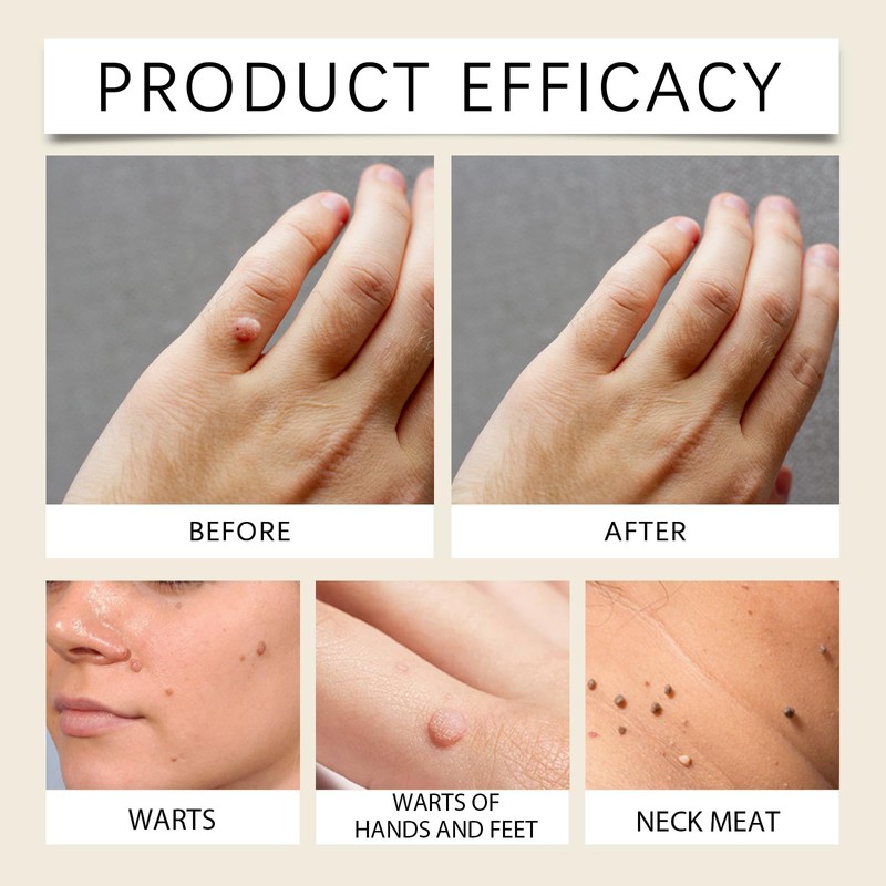 Wart Care Body Cream (01)