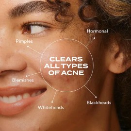 Tratamiento Antiacné Murad Biome-balancing: Suero Con Ácido