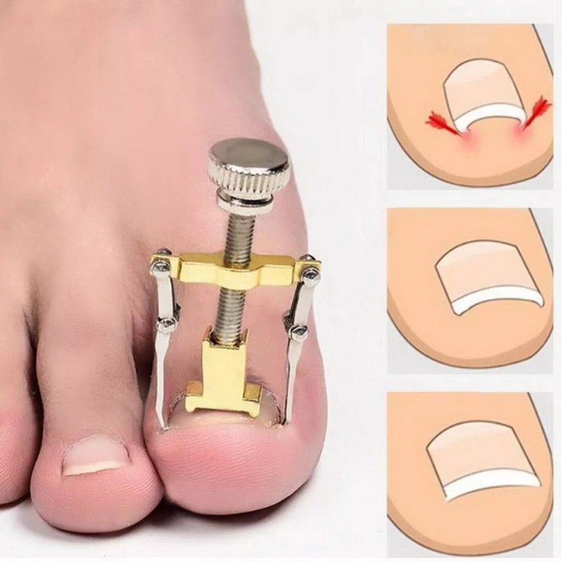 Universo en Linea Kit Corrección Uñas Encarnadas Pie Herramienta Pedicura