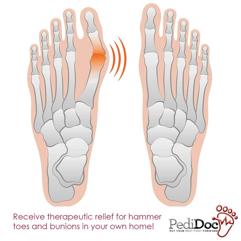 PediDoc Bunion Corrector Bunion Toe Straightener – Bunion Relief Big