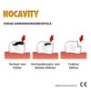 Nocavity - Temporary Tooth Filling Kit - Isolates the tooth