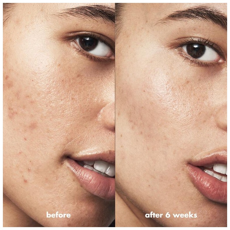 Blemish Breakthrough Acne Calming Water Cream