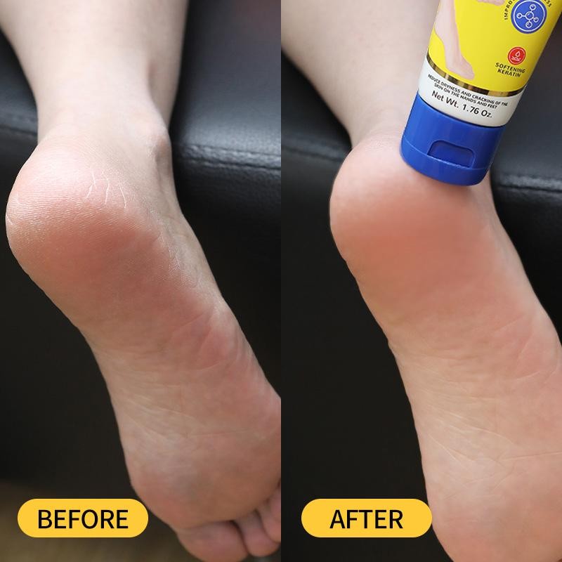 Aavini Intense Foot Cream - Repairs Cracked Skin, Antibacterial and