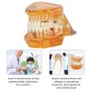Dental Model for Teaching, Bit Model of Dental Degeneration Demonstration