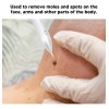 Maquina De Plasma Para Quitar Verrugas Genitales Sin Dolor