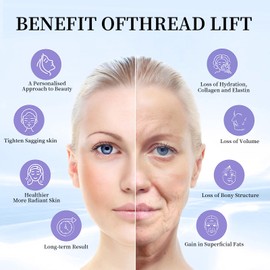 AEVEpdo PDO Threads 20pcs-pdo threads for face lift pdo mono screw threads collagen threads for face (A30G25MM)