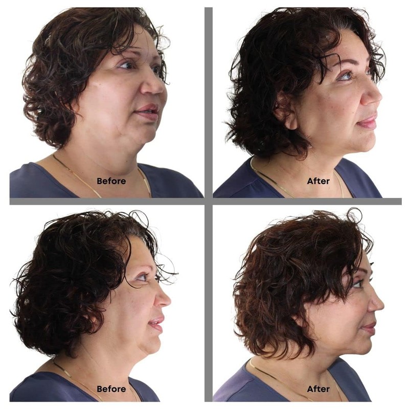 Bring It Up Instant Neck Lift Tape 30 Day Supply,