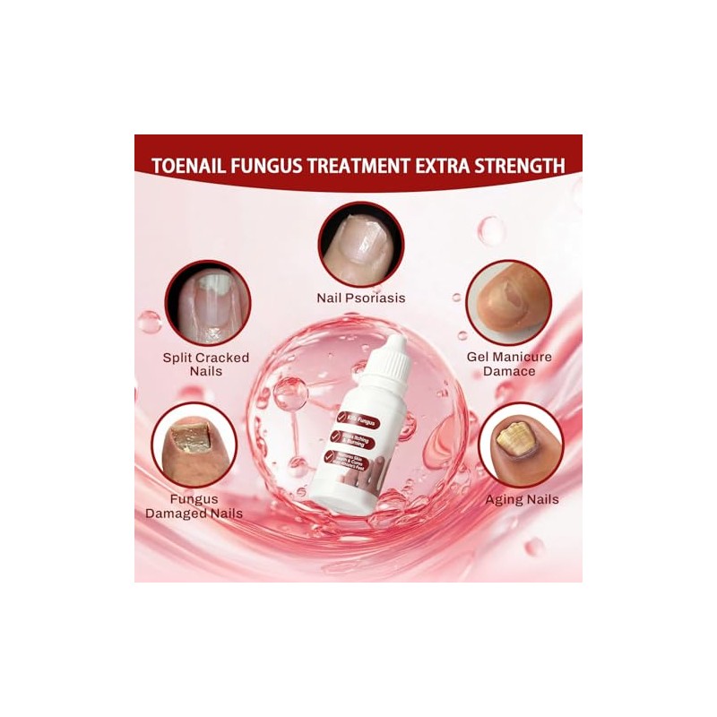Fungi Nail ToenailTreatment,Gentle Formula,Effectively lmproves Nails for a More Beautiful