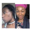 Herbal Power Peel Green Herbal Algae Peel- Acne Treatment Soap