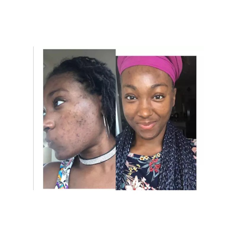 Herbal Power Peel Green Herbal Algae Peel- Acne Treatment Soap