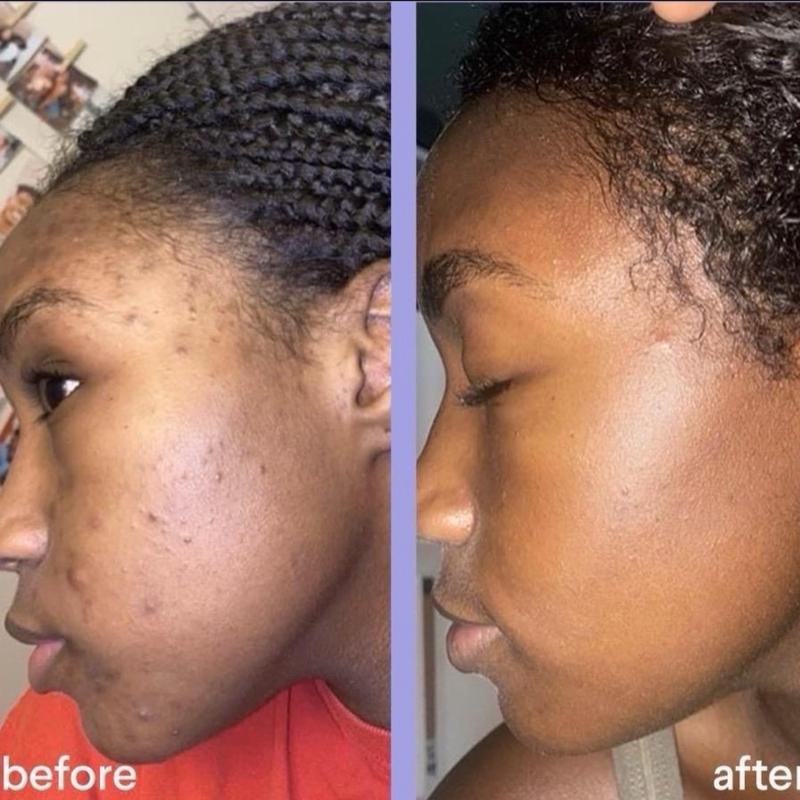 Turmeric & Kojic acid Soap