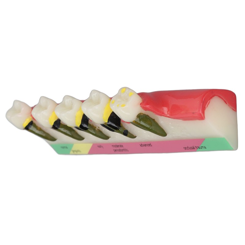 Dental Teeth Model Ceramic Clear Structure Oral Care Educational Periodontal