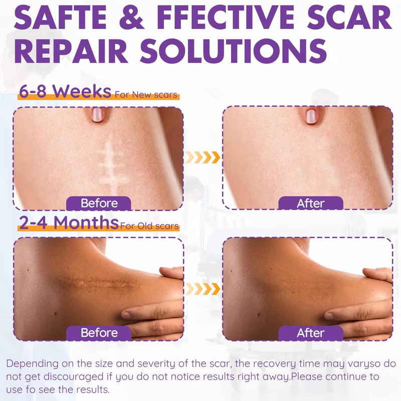 Silicone Scar Sheets, Silicone Scar Tape, Reusable Professional Scar Silicone
