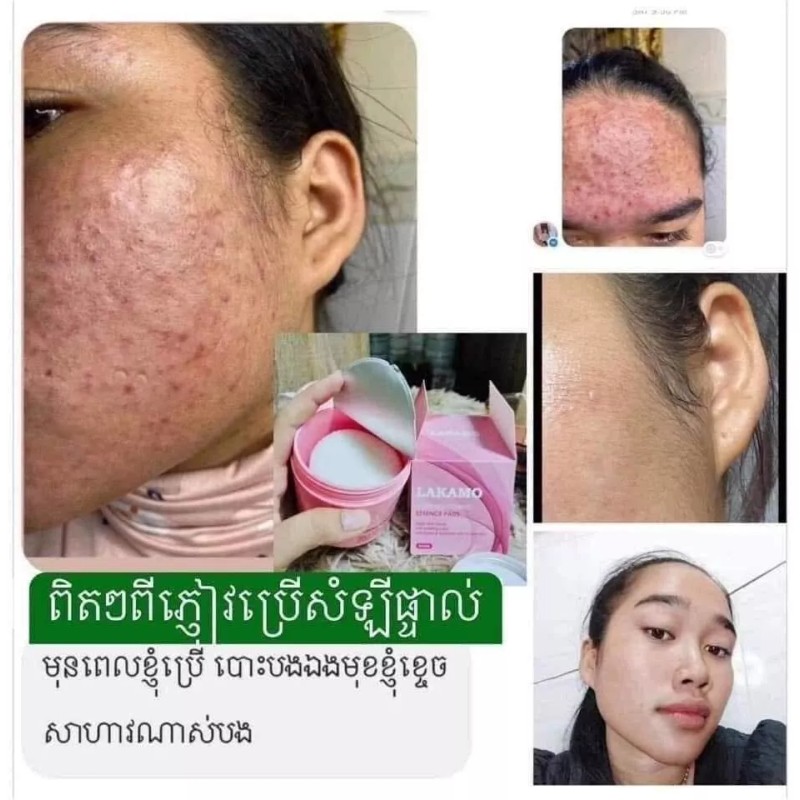 LAKAMO Pore Tightening Essence Pads សំឡីជូតមុខកូរ៉