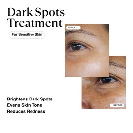 MATKAS Korean Dark Spot Remover for Face & Body Serum - for Uneven Skin Tone, Hyperpigmentation Treatment, Dark Spot Cream, Dark Spot Corrector, Spot Treatment - Niacinamide + Oat Extract + Green Tea