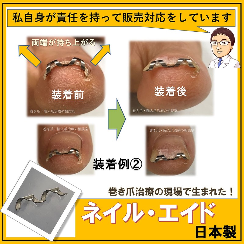 Nail Aid 0.6 inch (14 mm) Winding Nail Correction Self-Winding