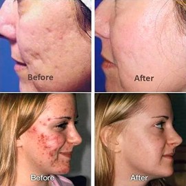 Esencia Ácido Hialurónico Hidratante Facial Reparadora 5pzs