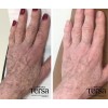 Crema Despigmentante Quita Manchas Acné Paño Vitíligo De 30g