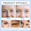 Parches De Gel Para Ojos Con Cafeína Y Ácido Hial