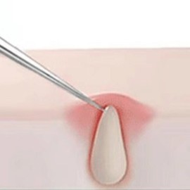 Pointed sebum tweezers, elementary school student blackheads, ear blackhead removal, underarm sebum removal / 뾰족피지핀셋 초등학생블랙헤드 귀블랙헤드제거 겨드랑이피지제거
