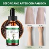 Aceite Cyperus Rotundus Natural Reducción Vello Corporal