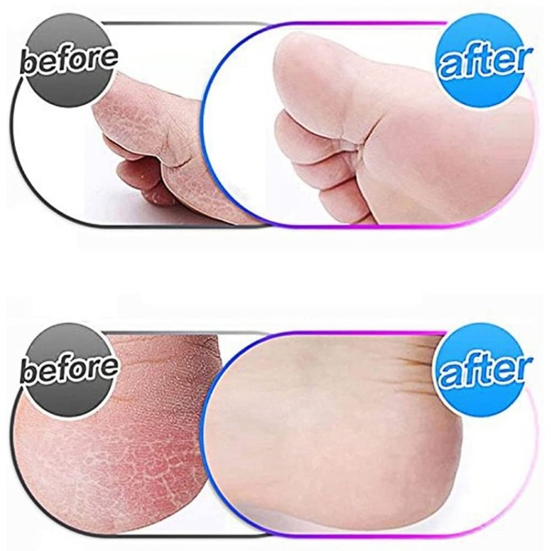 Hsthe Sea 4 Pack Extra Coarse Mineral Replacement Rollers Mineral