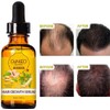 Tratamiento de pérdida de cabello Esencia de crecimiento del cabello