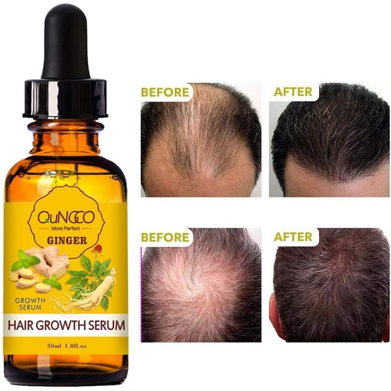 Tratamiento de pérdida de cabello Esencia de crecimiento del cabello