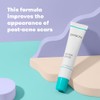 Gel facial para tratamiento de cicatrices de acné
