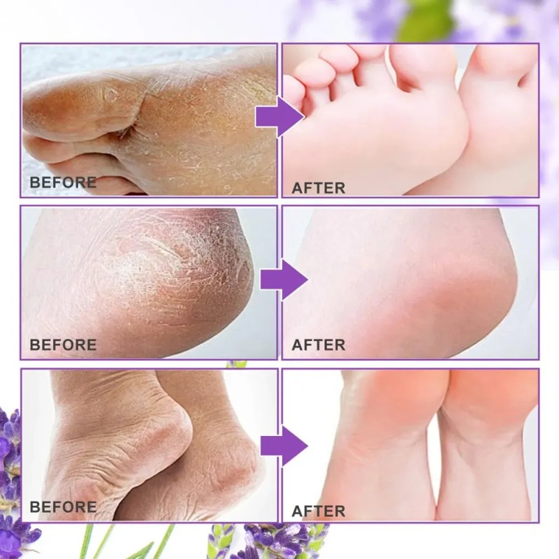 Mascarilla Exfoliante Para Pies - Pack De 5 Pares Para