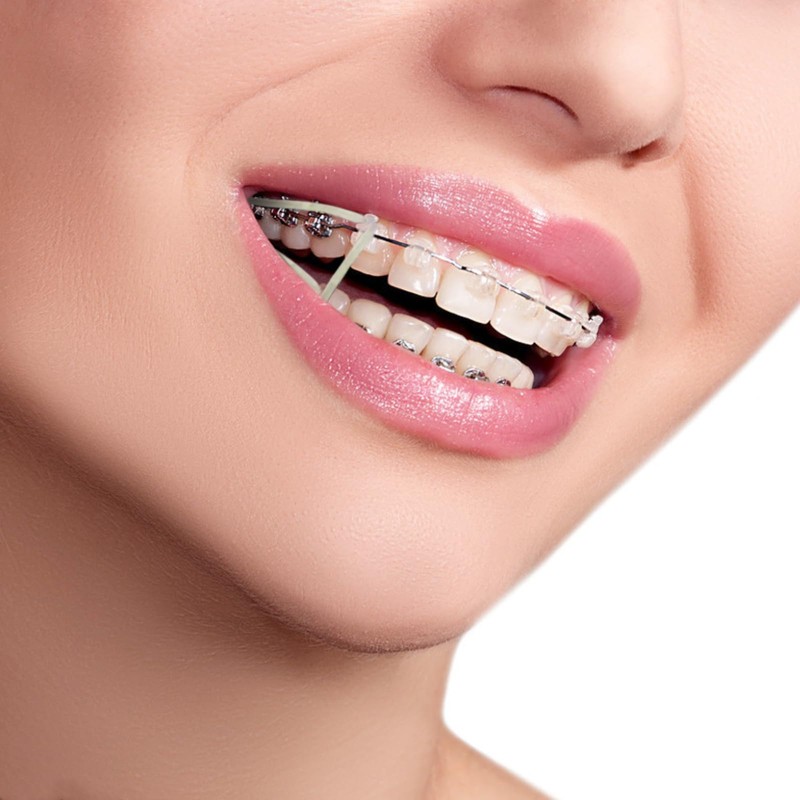 Xumann 400 PCS Orthodontic Elastic Bands, Braces Band for Dentist