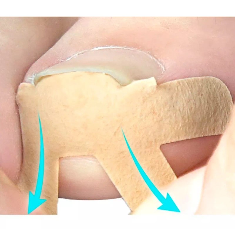 Universo en Linea Pegatinas Correctoras De Uñas Enterradas 4 Plantillas