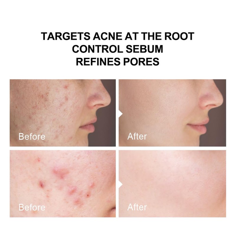 pure.tiful 2% Salicylic Acid (BHA) Serum for Acne & Blackheads