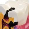Sarini Tooth Model, Caries Comparative Study Model,Dentist Dental Anatomy Educational