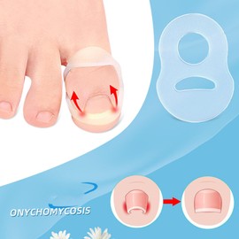 10 Pcs Toenail Corrector, Stretch Silicone Reusable Ingrown Toe Nail Correct Brace Ring for Nail